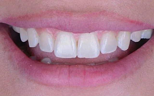 Antes: sonrisa con dientes de distinto tono y forma