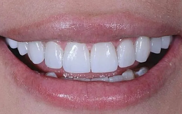 Después: sonrisa con carillas, más pareja y luminosa