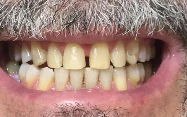 Antes: dientes superiores amarillos, con espacios entre ellos y un borde fracturado